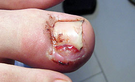 Eingewachsener Nagel