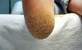 Hyperkeratose an der Ferse