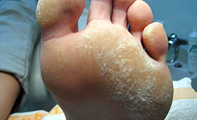 Hyperkeratose Vorfuß